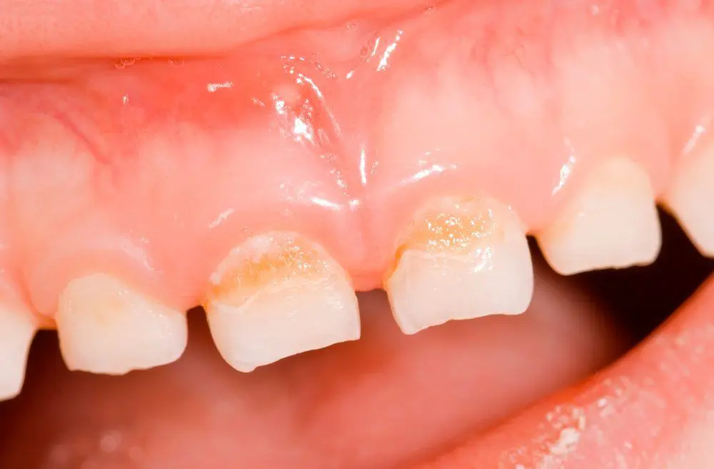 Bottle Rot Decay: What Is It? And Can It Be Prevented?
